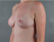 Breast Reduction After Photo by Patti Flint, MD; Scottsdale, AZ - Case 36384