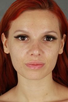 Rhinoplasty After Photo by Patti Flint, MD; ,  - Case 36387