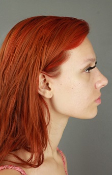 Rhinoplasty After Photo by Patti Flint, MD; ,  - Case 36387