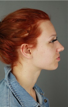 Rhinoplasty Before Photo by Patti Flint, MD; ,  - Case 36387