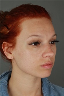 Rhinoplasty Before Photo by Patti Flint, MD; ,  - Case 36387