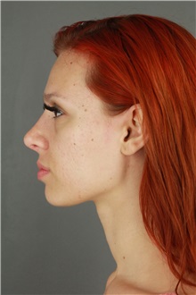 Rhinoplasty After Photo by Patti Flint, MD; ,  - Case 36387