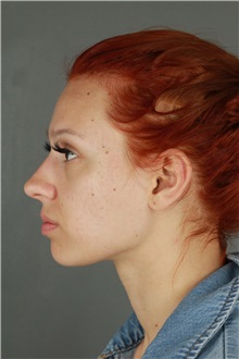 Rhinoplasty Before Photo by Patti Flint, MD; ,  - Case 36387