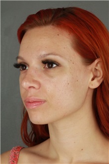 Rhinoplasty After Photo by Patti Flint, MD; ,  - Case 36387