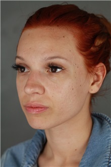 Rhinoplasty Before Photo by Patti Flint, MD; ,  - Case 36387