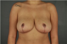 Breast Reduction After Photo by Patti Flint, MD; Scottsdale, AZ - Case 37904