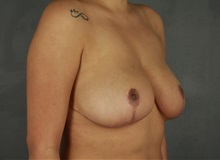 Breast Reduction After Photo by Patti Flint, MD; Scottsdale, AZ - Case 37904
