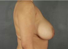 Breast Reduction Before Photo by Patti Flint, MD; Scottsdale, AZ - Case 37904