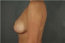 Breast Reduction After Photo by Patti Flint, MD; Scottsdale, AZ - Case 37904