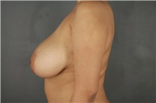 Breast Reduction Before Photo by Patti Flint, MD; Scottsdale, AZ - Case 37904