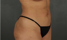 Liposuction After Photo by Patti Flint, MD; Scottsdale, AZ - Case 37908