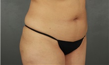 Liposuction Before Photo by Patti Flint, MD; Scottsdale, AZ - Case 37908