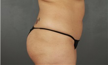 Liposuction Before Photo by Patti Flint, MD; Scottsdale, AZ - Case 37908