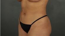 Liposuction After Photo by Patti Flint, MD; Scottsdale, AZ - Case 37908