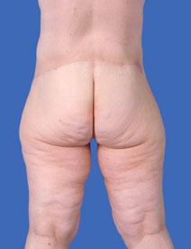 Body Contouring After Photo by Jeffrey Kenkel, MD; Dallas, TX - Case 3956
