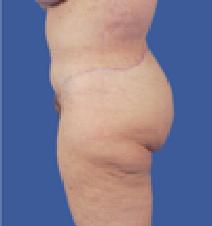 Body Contouring After Photo by Jeffrey Kenkel, MD; Dallas, TX - Case 5376