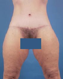Tummy Tuck After Photo by Jeffrey Kenkel, MD; Dallas, TX - Case 6573