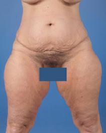 Tummy Tuck Before Photo by Jeffrey Kenkel, MD; Dallas, TX - Case 6573