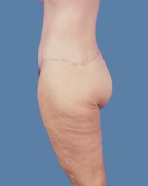 Tummy Tuck After Photo by Jeffrey Kenkel, MD; Dallas, TX - Case 6573