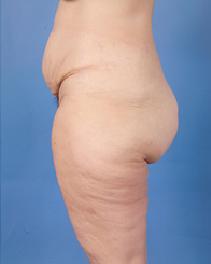 Tummy Tuck Before Photo by Jeffrey Kenkel, MD; Dallas, TX - Case 6573
