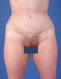 Tummy Tuck After Photo by Jeffrey Kenkel, MD; Dallas, TX - Case 6574