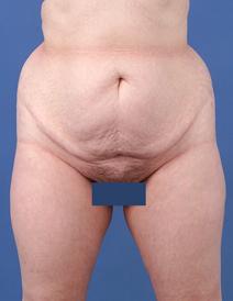 Tummy Tuck Before Photo by Jeffrey Kenkel, MD; Dallas, TX - Case 6574