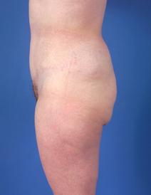 Tummy Tuck After Photo by Jeffrey Kenkel, MD; Dallas, TX - Case 6574