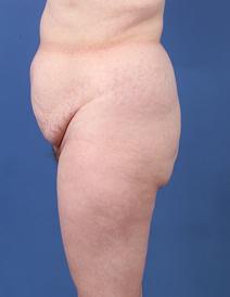 Tummy Tuck Before Photo by Jeffrey Kenkel, MD; Dallas, TX - Case 6574