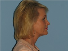 Facelift After Photo by Paul Vanek, MD, FACS; Concord, OH - Case 32698