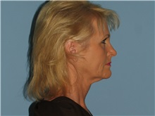 Facelift Before Photo by Paul Vanek, MD, FACS; Concord, OH - Case 32698