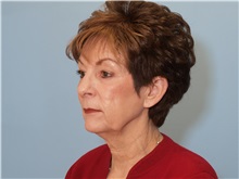 Facelift Before Photo by Paul Vanek, MD, FACS; Concord, OH - Case 32699