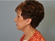 Facelift After Photo by Paul Vanek, MD, FACS; Concord, OH - Case 32699