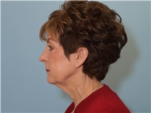 Facelift Before Photo by Paul Vanek, MD, FACS; Concord, OH - Case 32699
