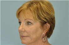 Brow Lift After Photo by Paul Vanek, MD, FACS; Concord, OH - Case 32701