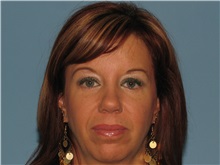 Brow Lift After Photo by Paul Vanek, MD, FACS; Concord, OH - Case 32702