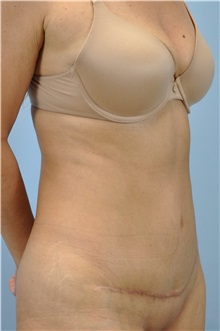 Tummy Tuck After Photo by Paul Vanek, MD, FACS; Concord, OH - Case 32705