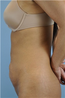 Tummy Tuck Before Photo by Paul Vanek, MD, FACS; Concord, OH - Case 32705