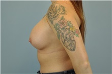Breast Augmentation After Photo by Paul Vanek, MD, FACS; Concord, OH - Case 32706