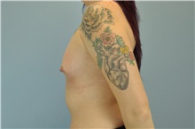 Breast Augmentation Before Photo by Paul Vanek, MD, FACS; Concord, OH - Case 32706