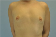 Breast Augmentation Before Photo by Paul Vanek, MD, FACS; Concord, OH - Case 32710