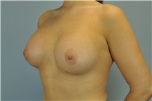 Breast Augmentation After Photo by Paul Vanek, MD, FACS; Concord, OH - Case 32710
