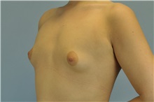 Breast Augmentation Before Photo by Paul Vanek, MD, FACS; Concord, OH - Case 32710