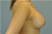 Breast Augmentation After Photo by Paul Vanek, MD, FACS; Concord, OH - Case 32710