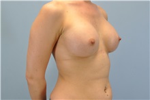 Breast Augmentation After Photo by Paul Vanek, MD, FACS; Concord, OH - Case 32711