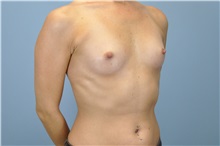 Breast Augmentation Before Photo by Paul Vanek, MD, FACS; Concord, OH - Case 32711