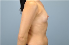 Breast Augmentation Before Photo by Paul Vanek, MD, FACS; Concord, OH - Case 32711