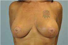 Breast Augmentation After Photo by Paul Vanek, MD, FACS; Concord, OH - Case 32712