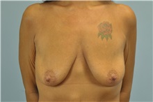 Breast Augmentation Before Photo by Paul Vanek, MD, FACS; Concord, OH - Case 32712