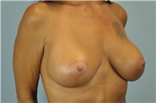Breast Augmentation After Photo by Paul Vanek, MD, FACS; Concord, OH - Case 32712