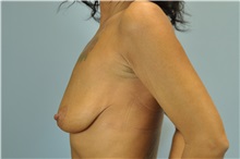 Breast Augmentation Before Photo by Paul Vanek, MD, FACS; Concord, OH - Case 32712